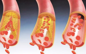 血栓溶解新突破：RT重组溶栓激酶
